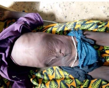 صور لأحد المصابين بسوء التغذية في قرية الزرافية بالحوض الشرقي